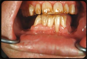 Comment prévenir les caries dentaires chez les enfants ?