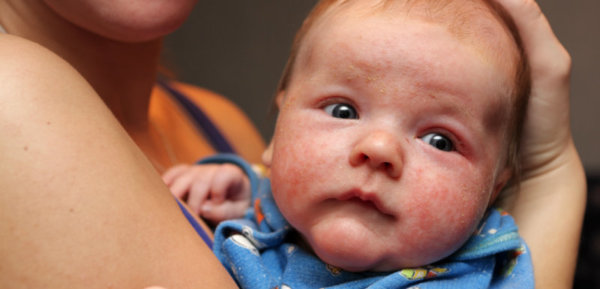 Les allergies chez les nourrissons